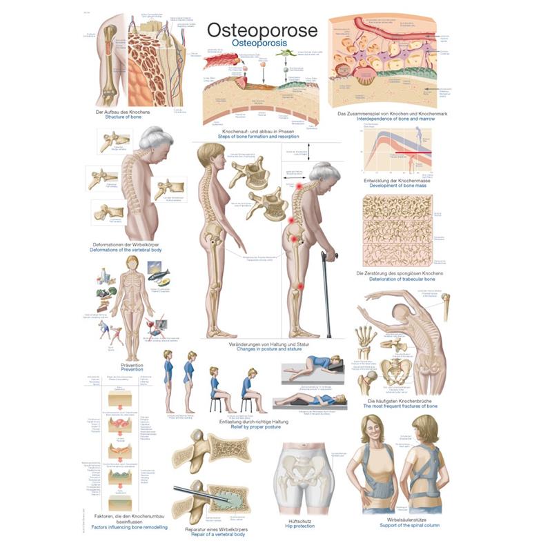 Plakat osteoporoza EZ104